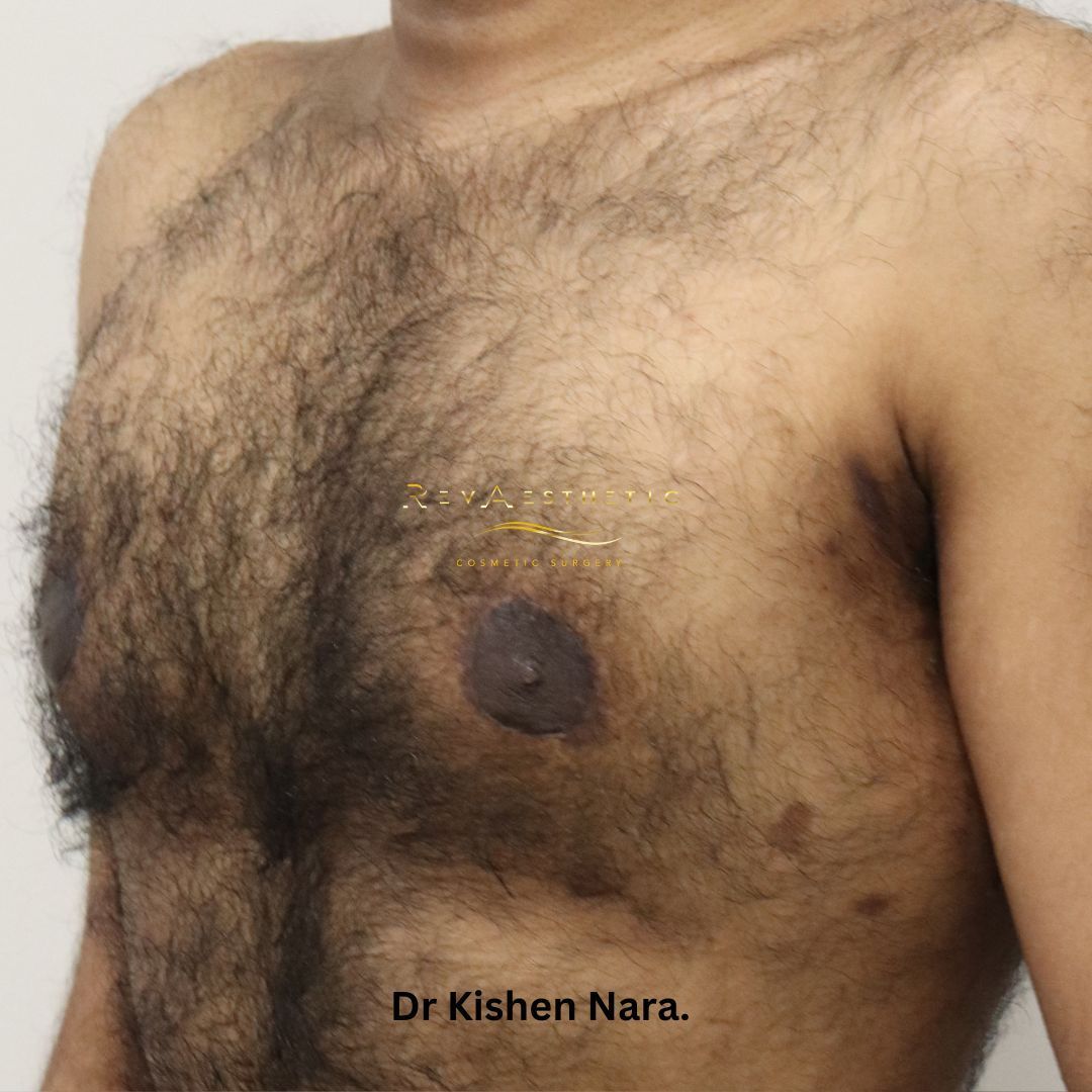 Chest liposuction + periareolar mastopexy + subcutaneous mastectomy — Anterior view — after